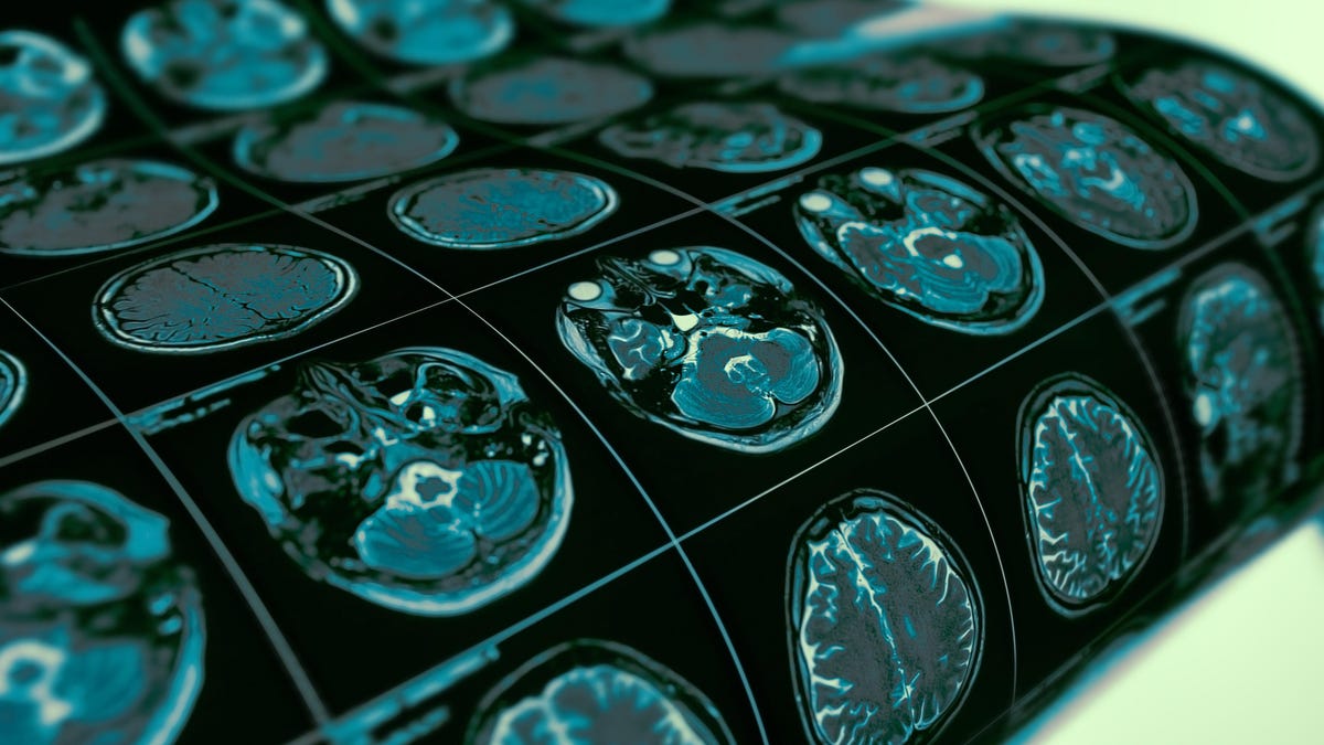 You're Practically Guaranteed to Get Alzheimer's If You Have This Genetic Variant