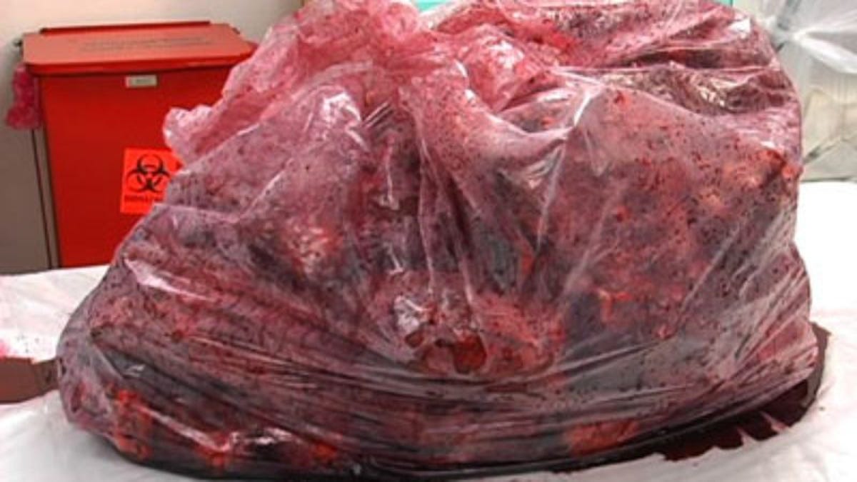 Anonymous Philanthropist Donates 200 Human Kidneys To Hospital