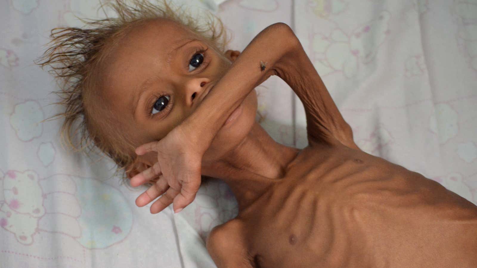 A malnourished boy lies on a bed at a hospital in the Red Sea port city of Houdieda, Yemen September 9, 2016. (Reuters/Abduljabbar Zeyad)