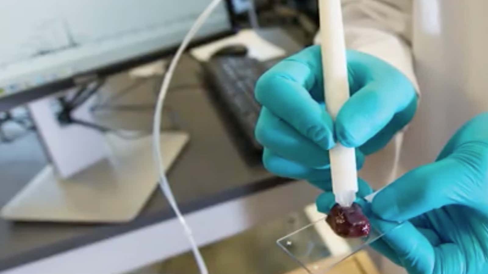 Pen-like device for cancer screening.