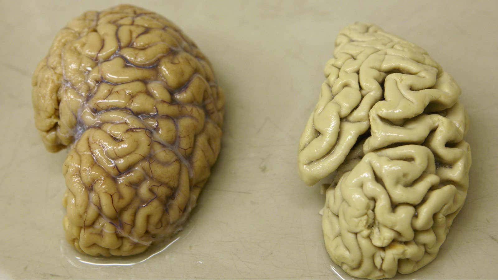 A healthy brain (left) next to a brain with Alzheimer’s disease.