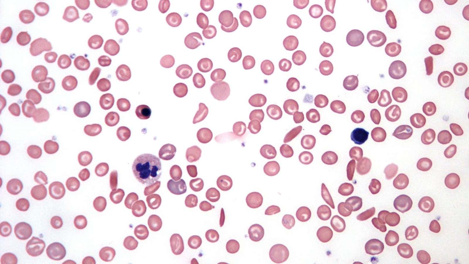 CRISPR Therapeutics is working on a gene-editing-based treatment for sickle-cell anemia, causes your body to produce abnormally shaped red blood cells.