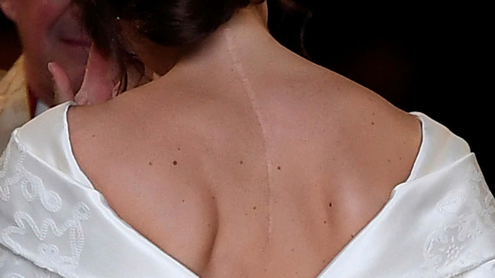 Princess Eugenie wanted wedding dress to show scoliosis back scar