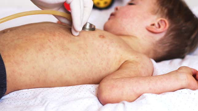A child with a measles rash.