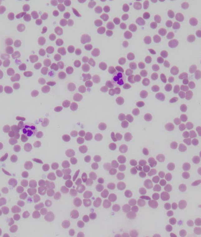 Laboratory slide of sickle cell disease, showing several sickle-shaped blood cells.