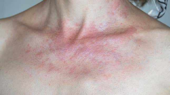 Image for article titled Your Rash Might Be a Sun Allergy