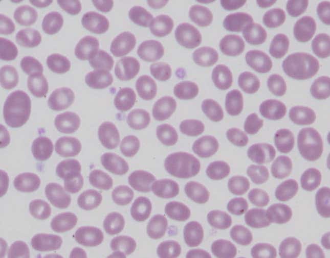 Laboratory slide of Southeast Asian ovalocytosis, showing Nutri-Grain-like cells with one or two horizontal bands.