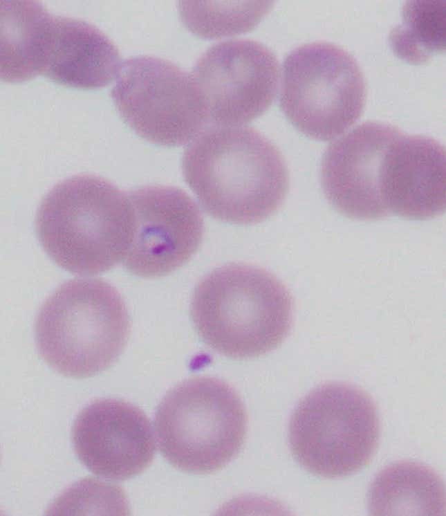 A laboratory slide showing a red blood cell containing a malaria parasite (purple ring with a dark purple dot).