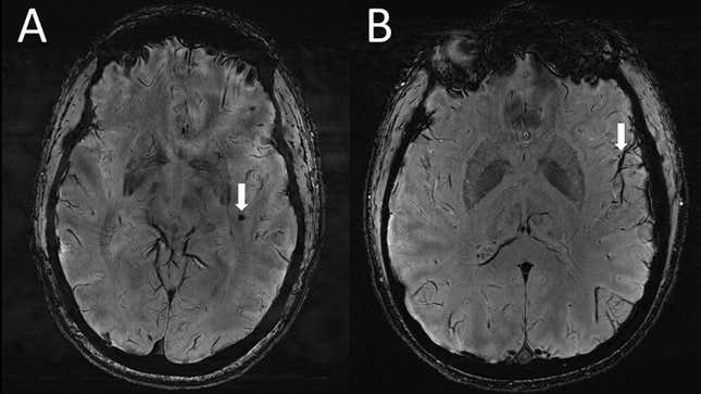 On the left, an arrow points to cerebral microbleeds captured in the left temporal lobe in a migraine case with aura. On the right, the arrow points to another possible abnormality on the same side of the microbleeds. 