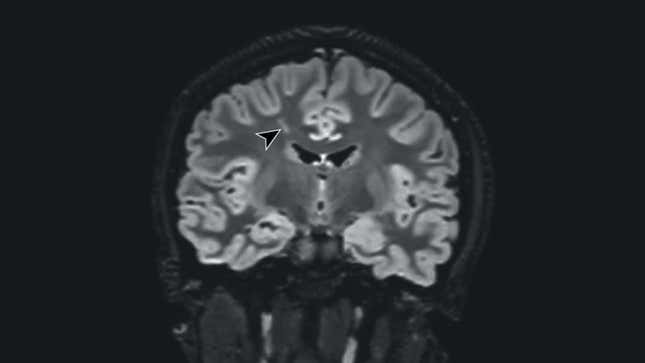 A MRI scan of one of the patients, with the arrow pointing to a suspected lesion.