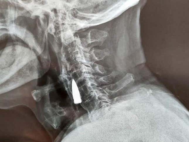 Radiografía que muestra la bala que ha vivido en el cuello de Zhao la mayor parte de su vida