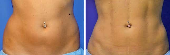 Vista frontal preoperatoria (izquierda) en comparación con una fotografía obtenida 6 meses después de la operación de una paciente con grabado de línea vertical y líneas de cadera definidas (derecha).
Foto: Journal of the American Society of Plastic Surgeons