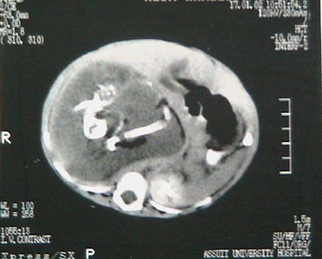 Imagen para el artículo titulado Acude a urgencias por un fuerte dolor de estómago y le encuentran los restos de su gemelo parcialmente formado