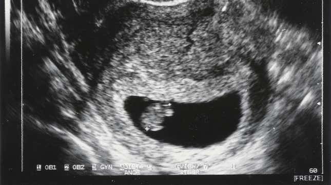 ultrasound image of a tiny blob