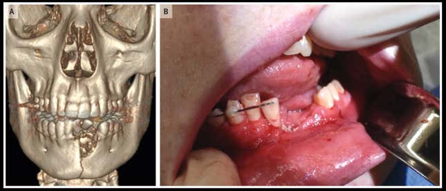 Imagen para el artículo titulado Este joven tiene la boca sellada después de fracturarse la mandíbula y los dientes al estallar su cigarro electrónico