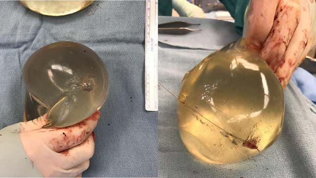 Imagen para el artículo titulado Una mujer sobrevive a un disparo gracias a sus implantes de mama