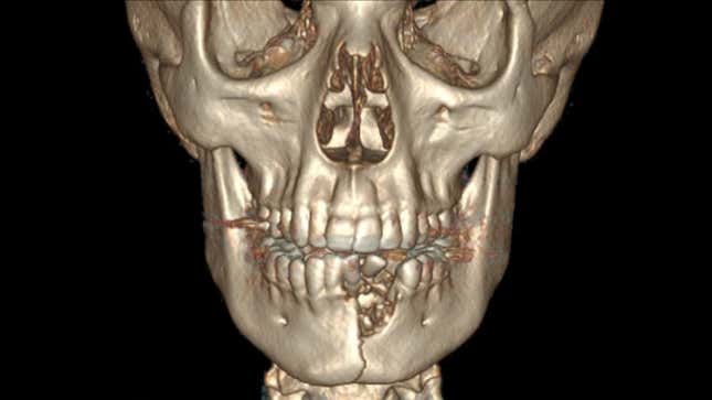 Imagen para el artículo titulado Este joven tiene la boca sellada después de fracturarse la mandíbula y los dientes al estallar su cigarro electrónico