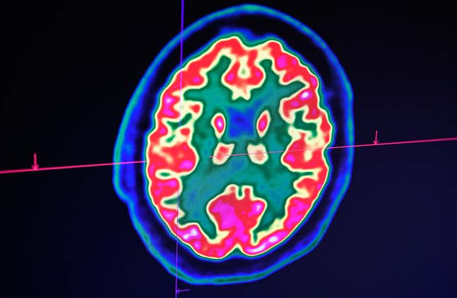 A picture of a human brain taken by a positron emission tomography scanner, also called a PET scan.