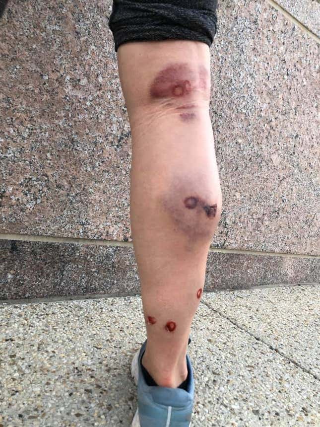 Liz Ferris’ right leg after a being hit by police stinger grenade at Black Lives Matter Plaza.