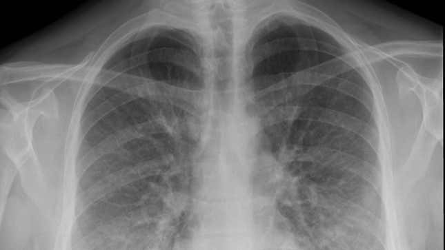 A chest X-ray taken of a early victim of EVALI in Utah