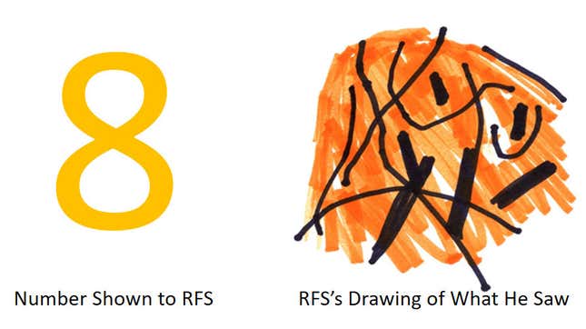 Since 2011, the patient known as RFS has only been able to see wavy lines when looking at the digits 2 through 9. 