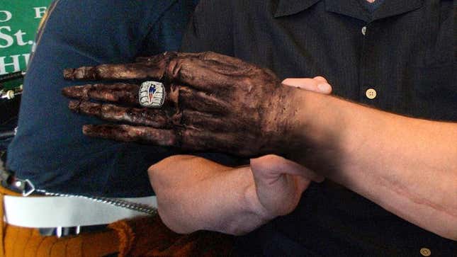 Image for article titled Patriots Horrified After New Super Bowl Rings Cause Fingers To Shrivel Up, Turn Black