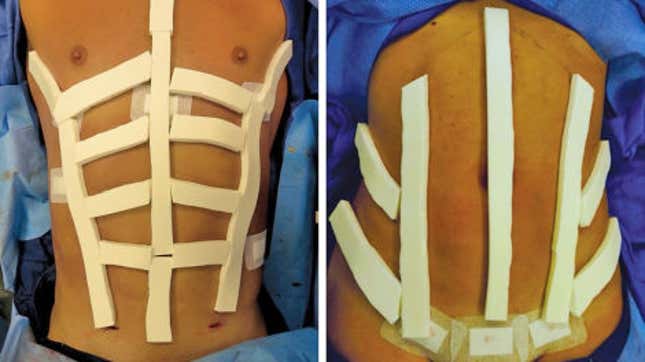 (Izquierda) Vista intraoperatoria con TopiFoam colocado para un paciente masculino. (Derecha) Vista intraoperatoria con TopiFoam colocado para una paciente.
Foto: Journal of the American Society of Plastic Surgeons