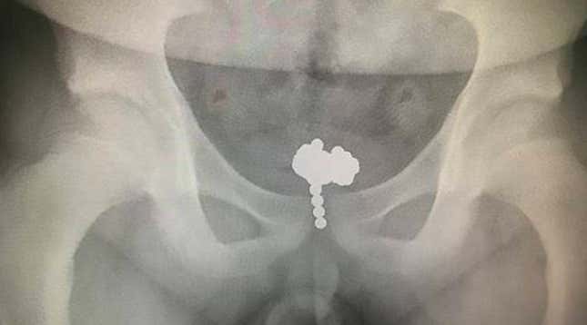 Imagen para el artículo titulado Un niño acude a urgencias con dolor de estómago y le encuentran 70 bolas magnéticas en el pene