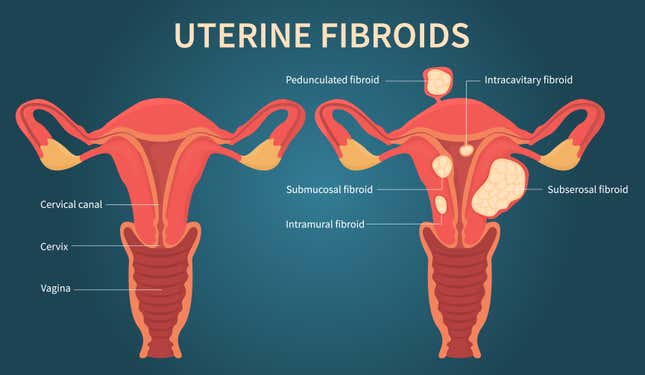 Image for article titled Fibroids 101