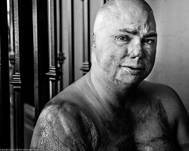 Staff sergeant Shilo Harris was severely burned on Feb. 19, 2007 by a road side bomb estimated at 700 lbs. He lost three men out of a crew of 5. Only Harris and his driver survived the blast.