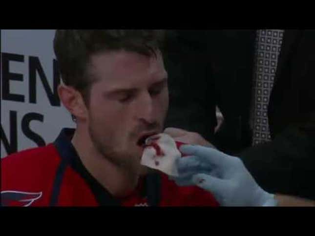 Caps' Player Removes Own Tooth