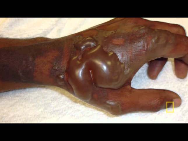 Stem Cell Shooting Gun Heals Massive Burns In Days