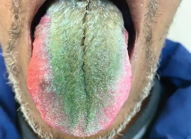 Unlike most cases, the man’s hairy tongue turned an odd shade of green.