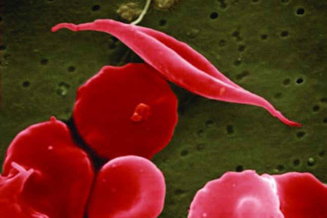 This electron microscope image provided by the National Institutes of Health in 2016 shows a blood cell altered by sickle cell disease, top. (National Center for Advancing Translational Sciences (NCATS), National Institutes of Health via AP)