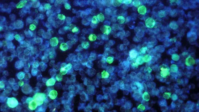In green, leukemia cells infected by the Epstein-Barr virus.