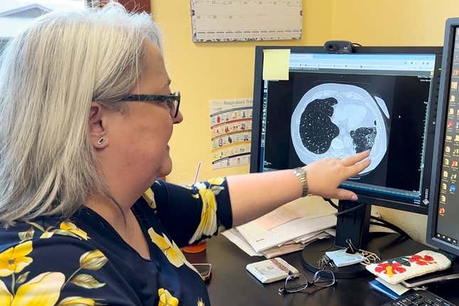 Dr. Lee Morissette shows an image of lungs damaged by asbestos exposure, at the Center for Asbestos Related Disease, Thursday, April 4, 2024, in Libby, Mont. The Libby area was contaminated by asbestos-contaminated vermiculite from a nearby mine that was shipped through by rail. The town has been largely cleaned up, but health officials say the long latency period for asbestos-related diseases means people will continue to be diagnosed with illnesses for years. (AP Photo/Matthew Brown)