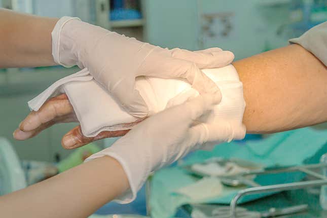 Dressing burned wound hand with gauze pad