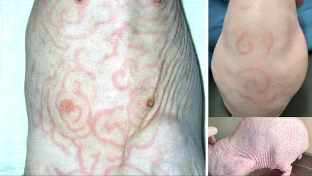 Figurate erythema documented in several sphynx cats. 