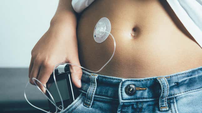 The artificial pancreas device combines an under-the-skin sensor to measure blood glucose with existing insulin pump technology, seen above, to more seamlessly deliver insulin to users when needed.