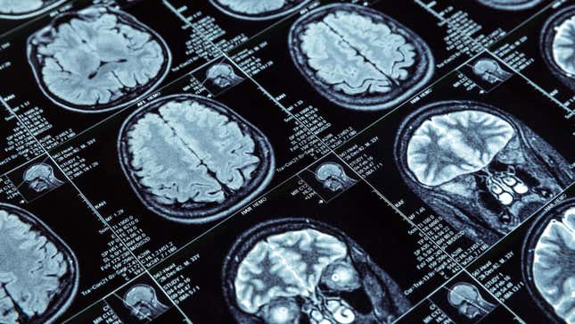 MRI brain scans.