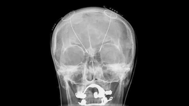 An example of what a deep brain stimulation device looks like under X-ray imaging.