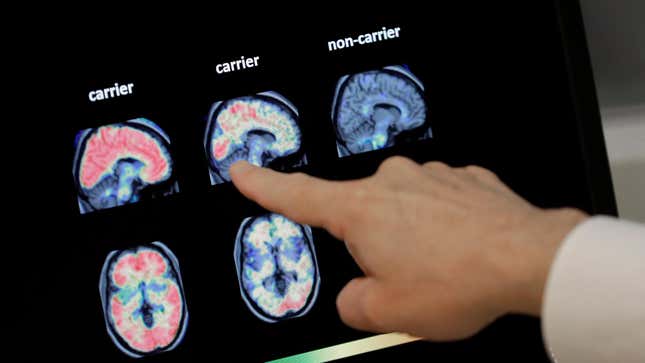 A doctor pointing to PET scans of people’s brains.