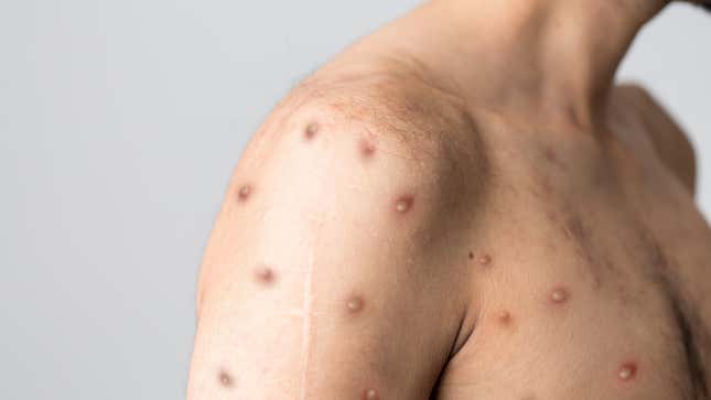 An example of monkeypox rashes. 