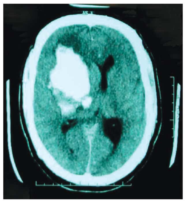 A tomography scan of the brain hemorrhage suffered by a tourist stung by several irukandjis at a beach in the Whitsundays.