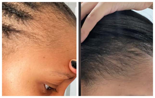 Image for article titled Black Women Are Using This Unusual Male Product to Regrow Their &#39;Edges&#39;