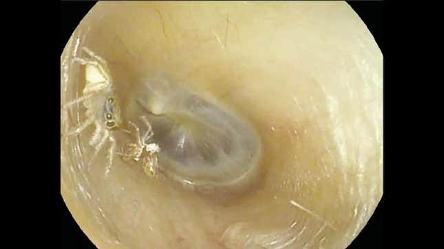 The spider and its molted exoskeleton found inside the woman’s ear.