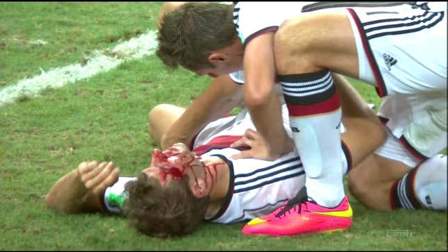Thomas Müller's Face Is A Bloody Mess