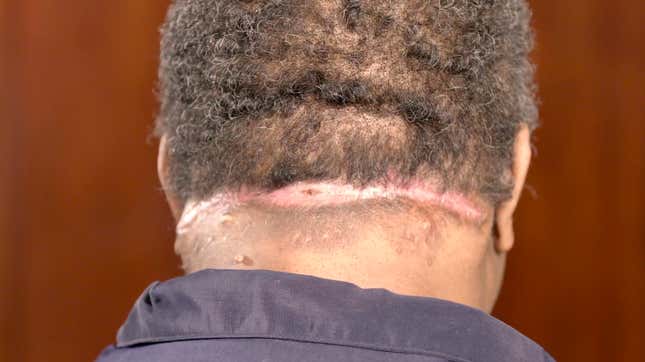 Image for article titled Dr. Pimple Popper and the Half-Head Removal
