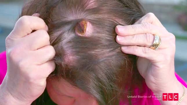 Image for article titled Beauty Tips From Someone With a 'Horse Hoof' Growing Out of Her Head, on Dr. Pimple Popper