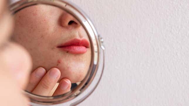 Image for article titled People With Acne Pay a Steep Social Price, Study Finds